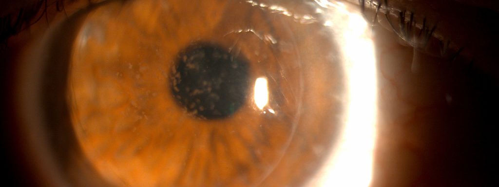 Cornea-Dystrophy-1280x480-1024x384-1