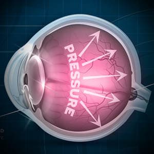 Eye-Gallery-Glaucoma