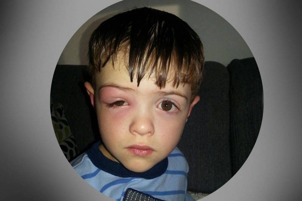 eye-issue-sore-eye-boy-1024x682-1