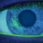 Eye with corneal scratch highlighted under blue light and fluorescein dye exam