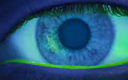 Eye with corneal scratch highlighted under blue light and fluorescein dye exam