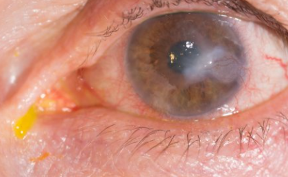 keratitis